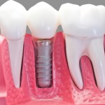 Implantologia Dentale, Domande e Risposte