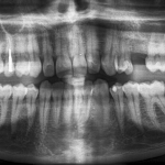 Panoramica Dentale, il Check Up per Denti in Salute