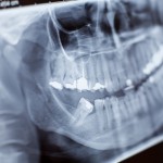 La Panoramica Dentale, l'Esame Completo per la Valutazione Orale
