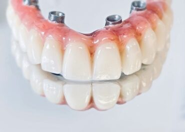 protesi su impianti a carico immediato